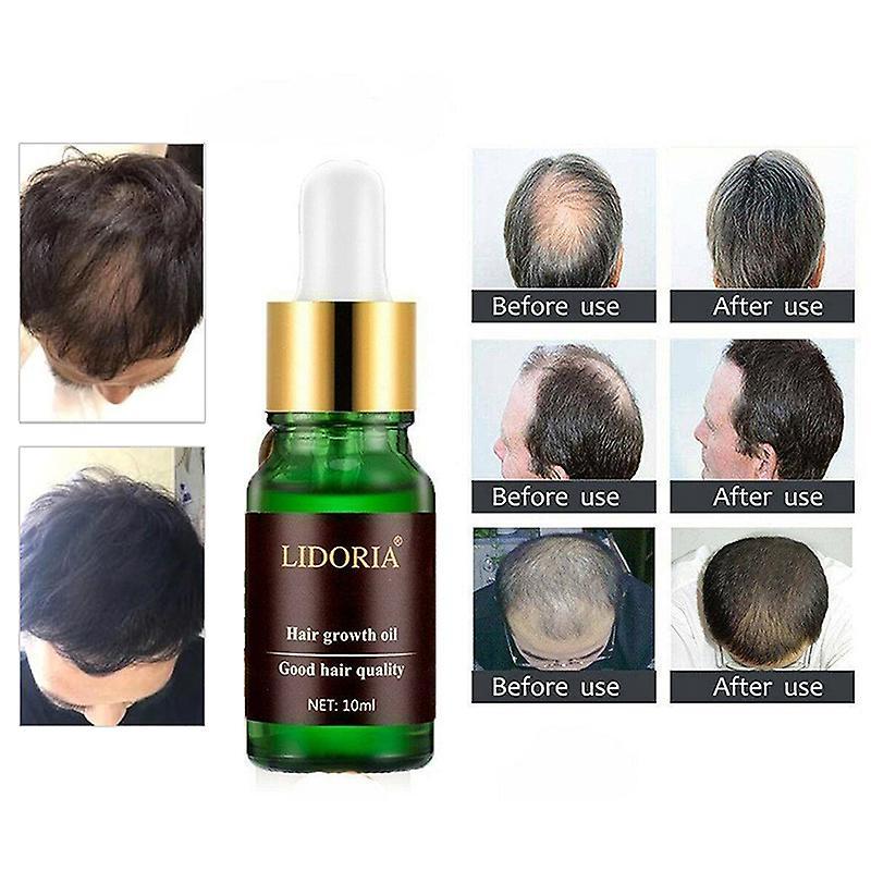 10ml Lidoria Powerful Hair Growth Essential Oil Hair Loss Nourishing Treatment