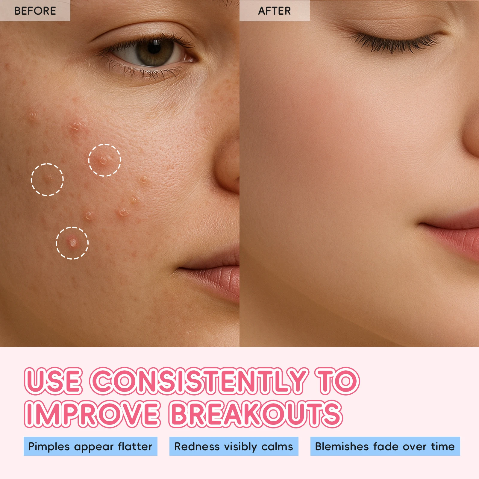 LAIKOU Sakura Acne Patch Invisible Hydrocolloid Pimple Patches for Face Concealing Zit Sticker Blemish Cover 24 Pcs