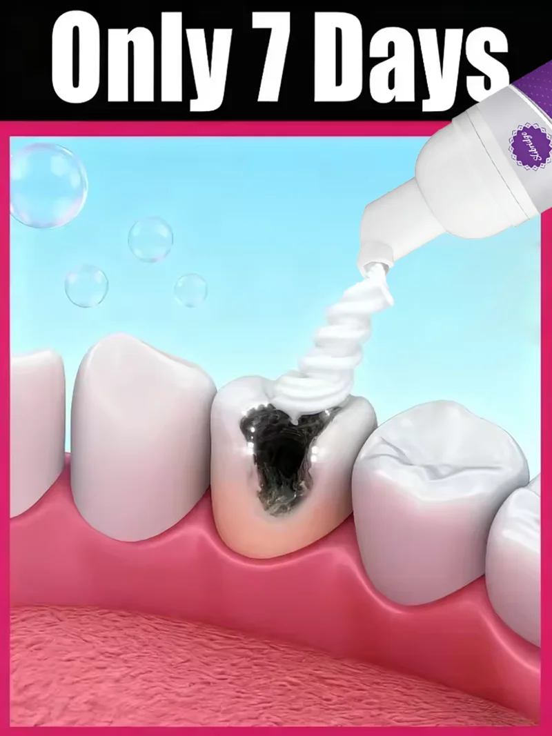Tooth Decay Repair All Cavities, Protect Teeth Remove Plaque Stains Tooth Decay Repair Teeth Whitening Dental