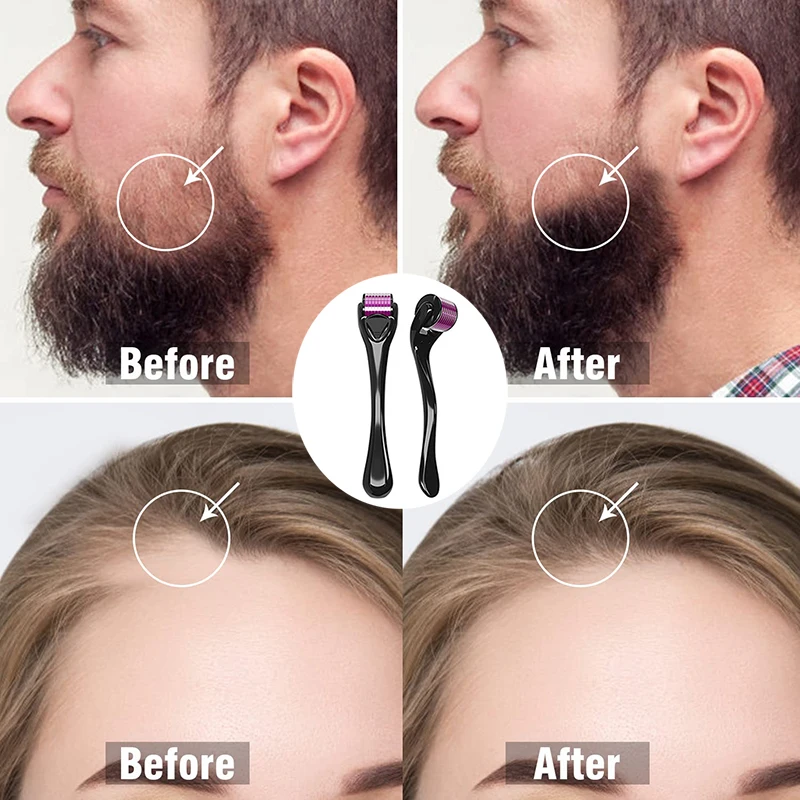 540  Microneedle Derma Roller – Stainless Steel Beard Growth & Hair Regrowth Tool for Scalp, Face Firming & Skin Care