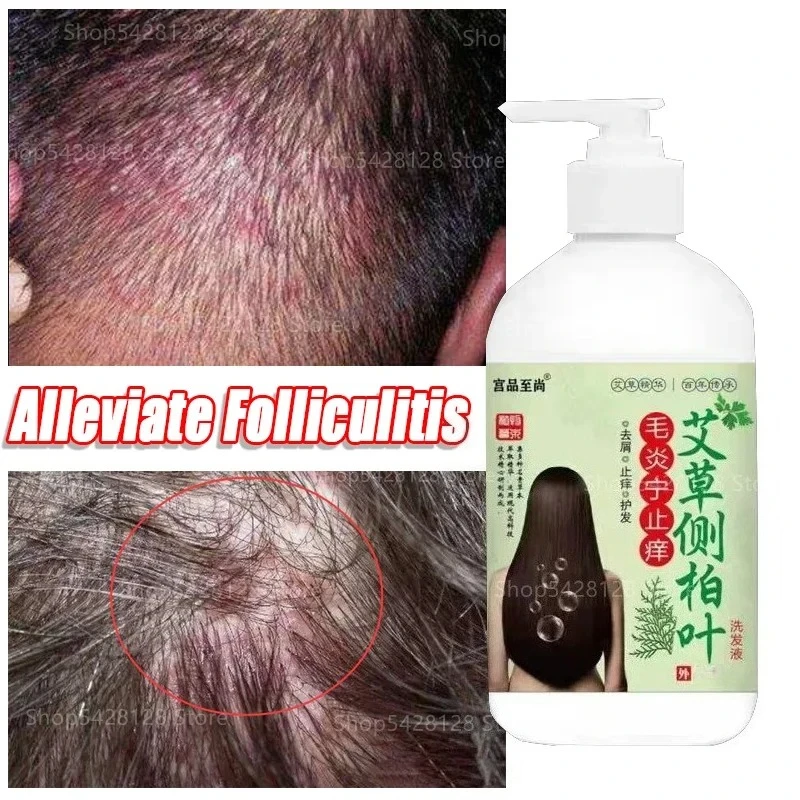 Wormwood Relieves Folliculitis Shampoo, Dandruff, Itching, Oil Control, Mites, Seborrheic Scalp Pustules and Pimple Cream