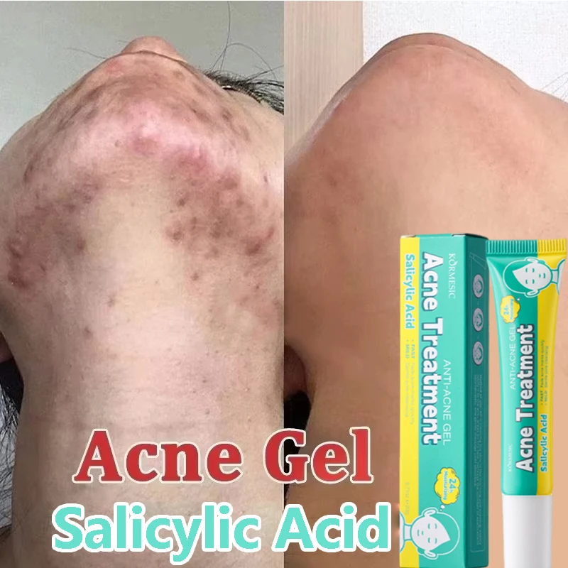 Salicylic Acid Acne Cream Fast Gently Repair Acne Spot Scar Shrinks Pores Gel Brightens Skin Tone Tightens Skin Korean Skincare