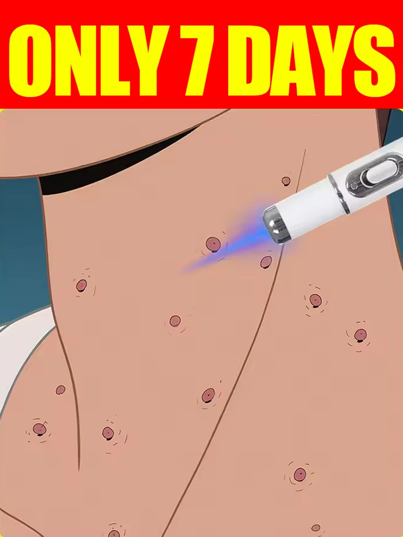 2026 NEW Blue Light Pen to Solve Axillary Warts, Genital Wart Care Tools.