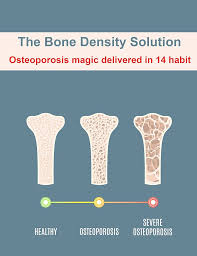 Osteoporosis- he Bone Density Solution