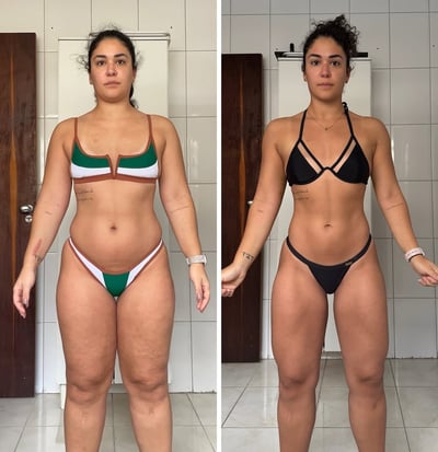 Treino Lipedema - Suzane