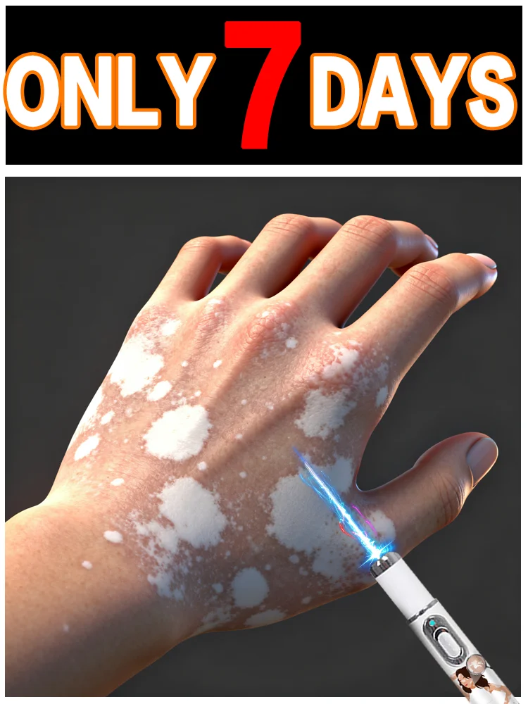 Vitiligo laser second generation upgraded version ⸴ Vitiligo treatment kit ⸴ Fast