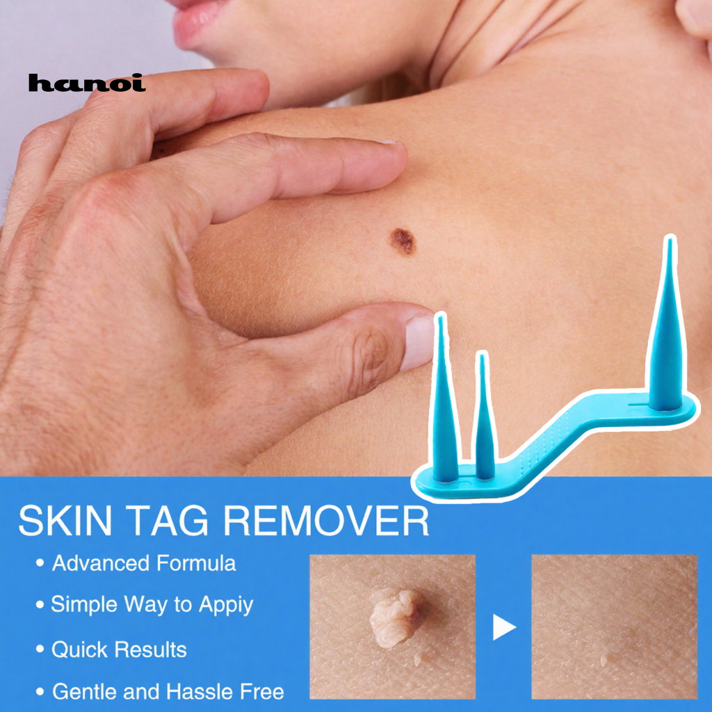 Body Skin Tag Remover Safe Effective Device – One-handed User-friendly Personal Care Kit for Home Use Easy Painless Re