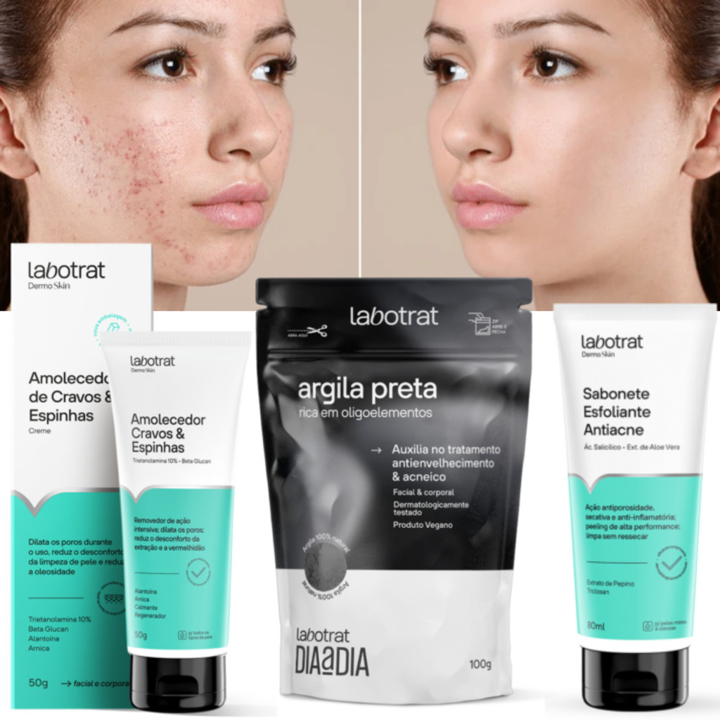 Kit antiacne espinhas cravos completo creme amolecedor sabonete esfoliante mascara facial argila