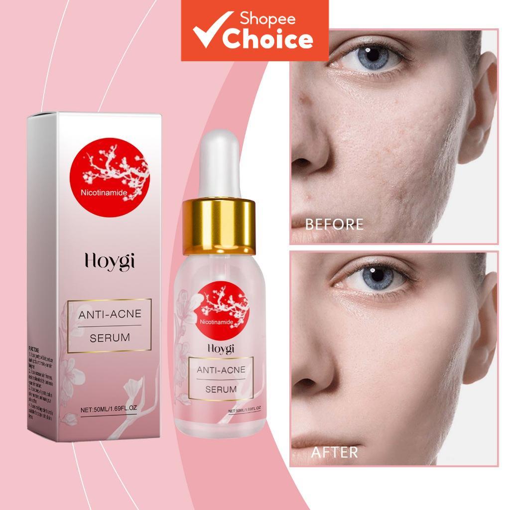 Antiacne para Poros Dilatados, Acne e Oleosidade, Facial de Niacinamida, Clareador, Leve e Hidratante para Imperfeições,