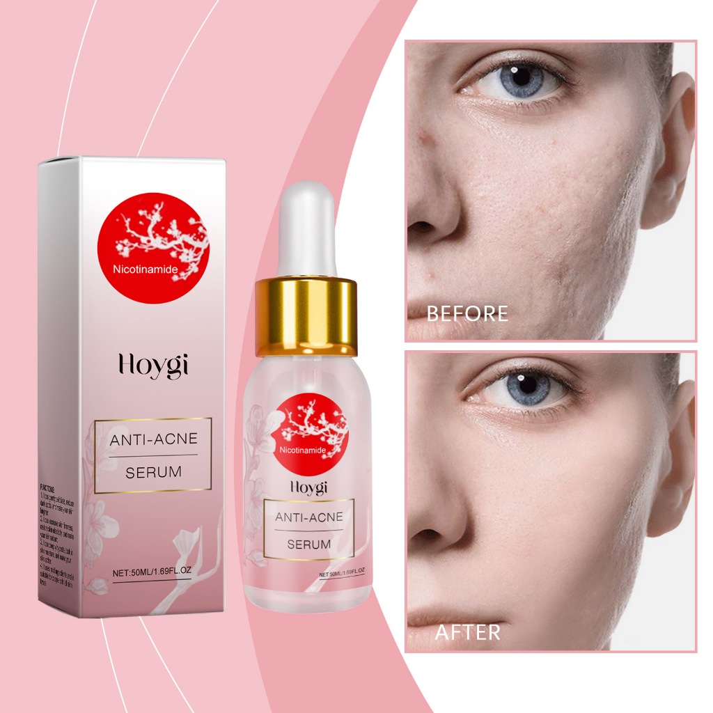 Antiacne para Poros Dilatados, Acne e Oleosidade, Facial de Niacinamida, Clareador, Leve e Hidratante para Cuidados com