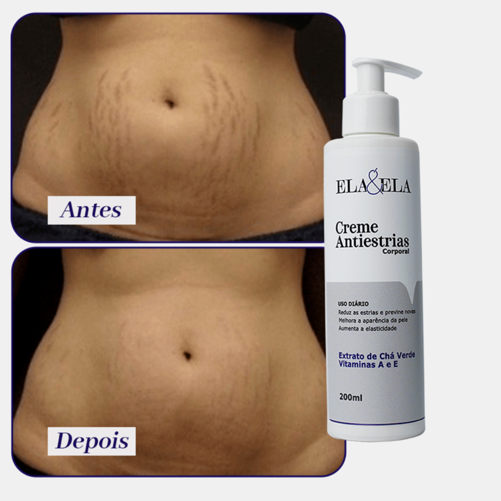 Creme Anti-Estrias Corporal -  Combate Estrias Vermelhas e Brancas + Pele Mais Firme e Elástica