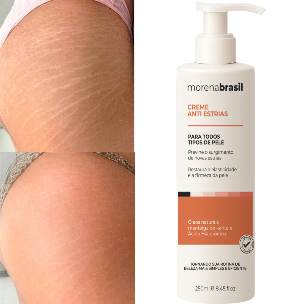 Creme Anti-Estrias Morena Brasil - Combate e Remove Estrias Vermelhas – Máxima Regeneração da Pele