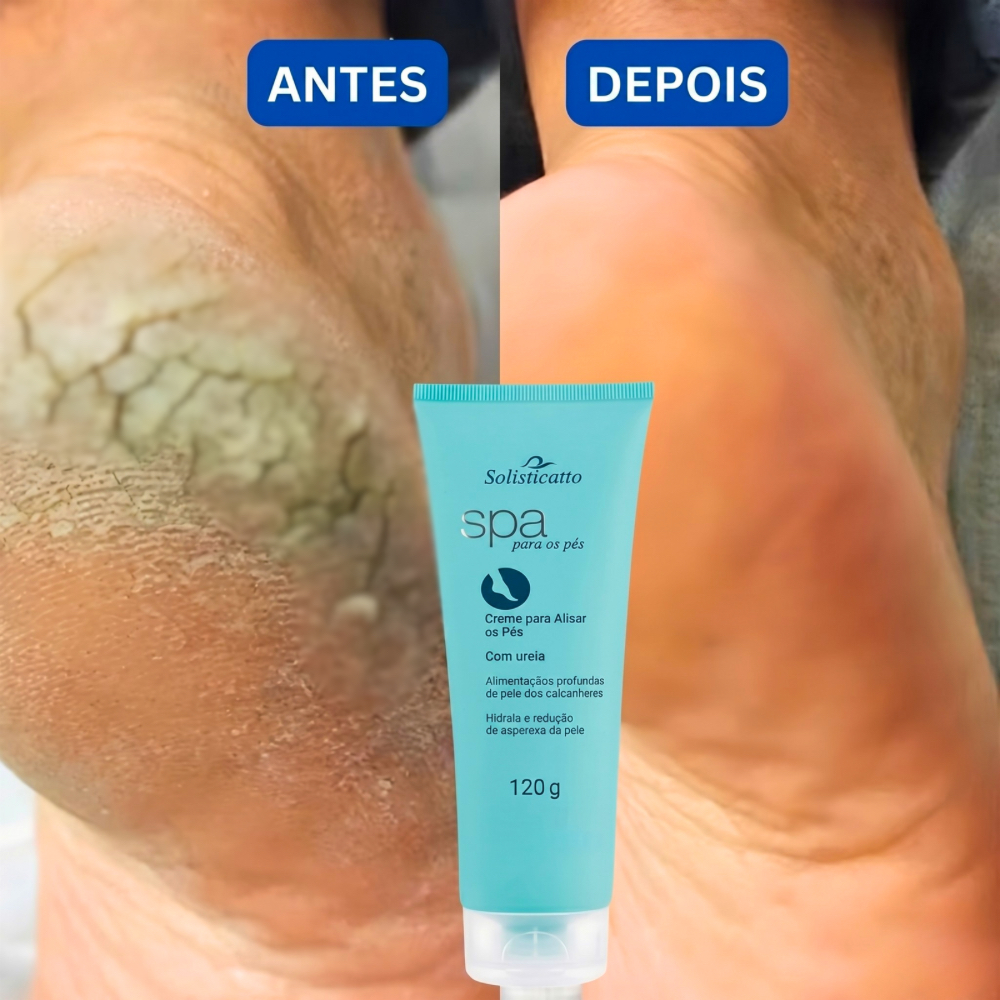 Creme para Pés Rachados e rachaduras Ressecados e Fissurados Spa dos Pés Ureia  Hidratação calcanha