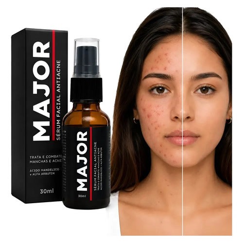 Sérum Facial Antiacne Com Niacinamida Zinco Pca Poros Abert Todo Tipo De Pele Dia/noite