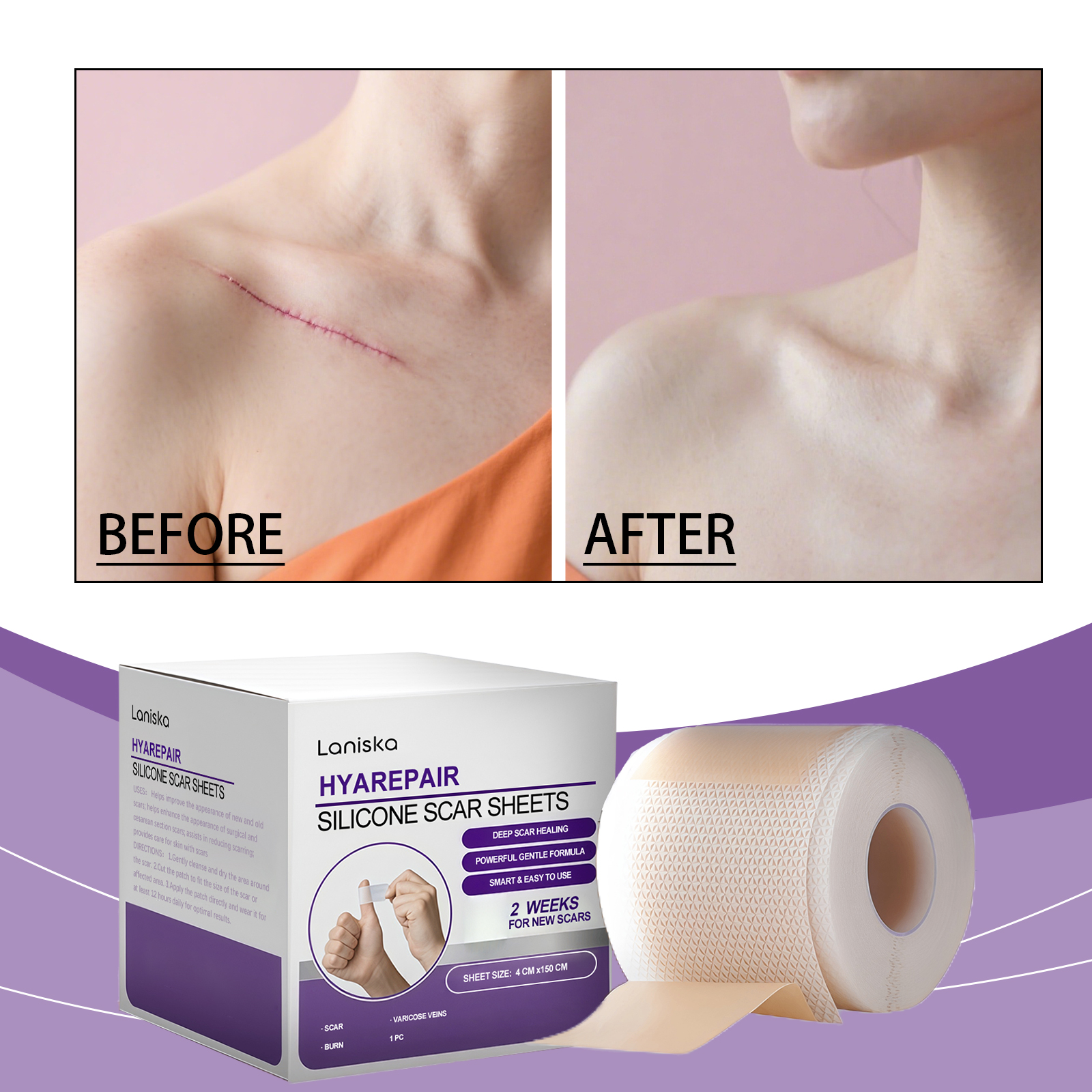 Fita de Silicone Grau Médico para Cicatrizes Cirúrgicas, Lençóis Eficazes para Remoção de Cicatrizes de Seção C, Tiras
