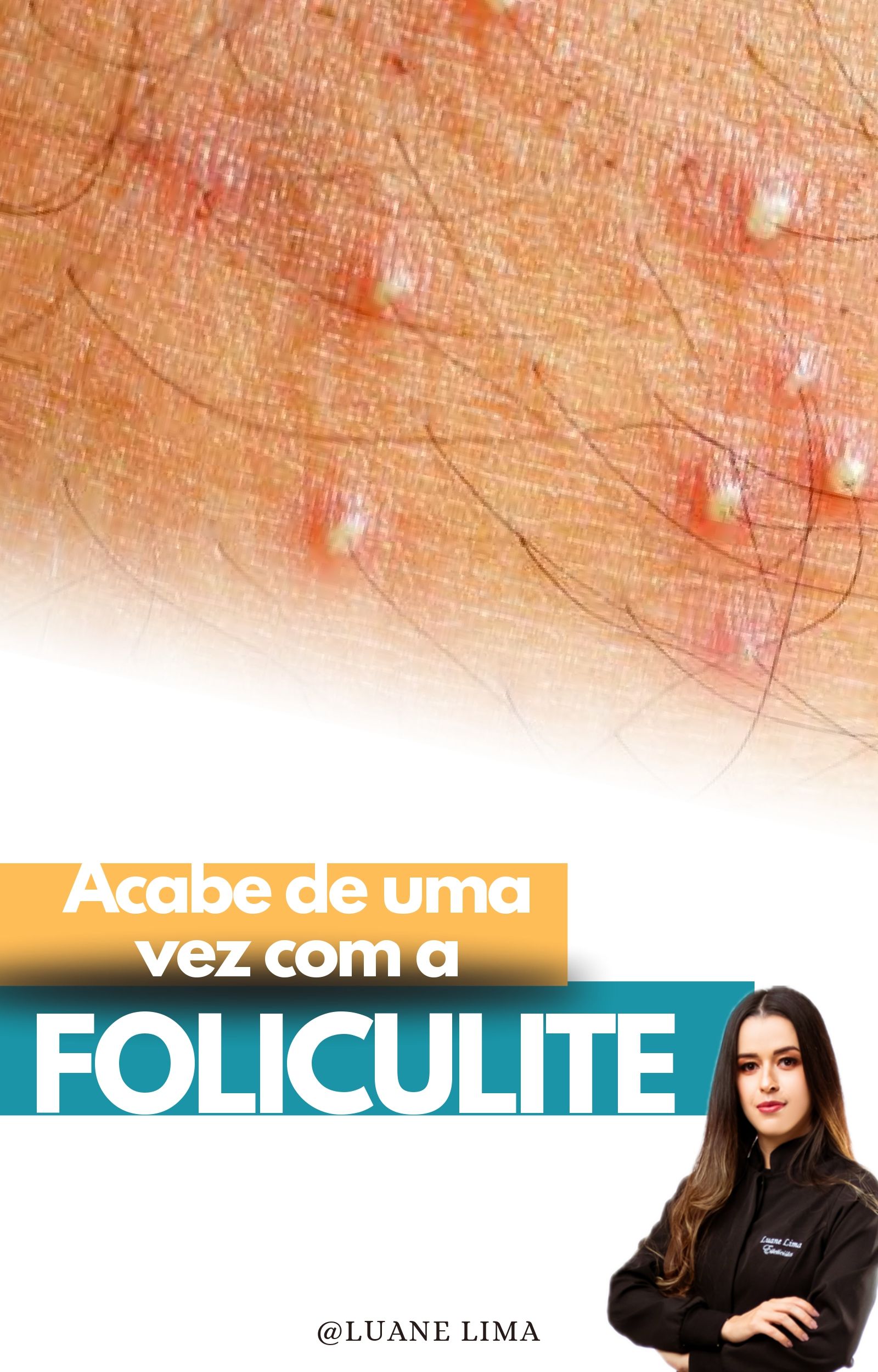 Foliculite Luane Lima