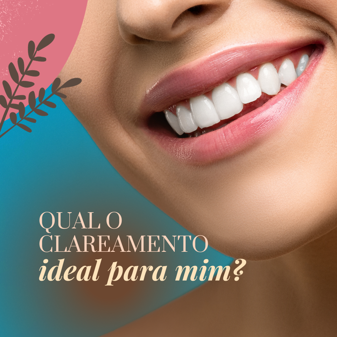Clareamento Dental: O Guia Definitivo para Ter Um Sorriso Brilhante