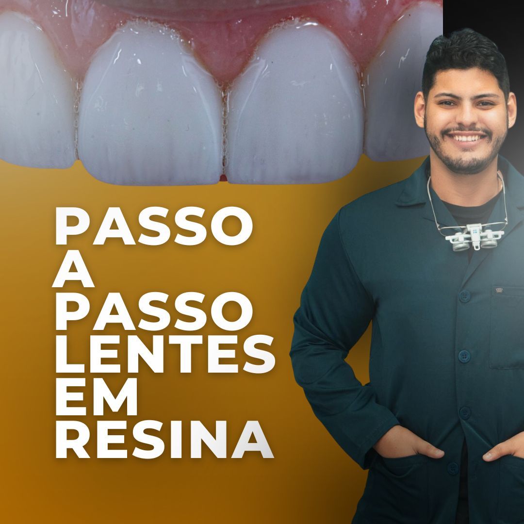 Passo a passo: Facetas em Resina