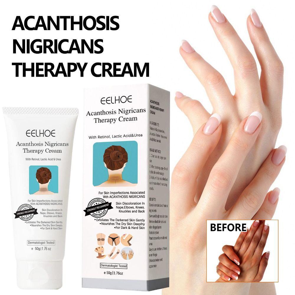 GODNESSFO Acantose Nigricans Therapy Cream 50g Glow White Moist Creme Corretor De Manchas Escuras