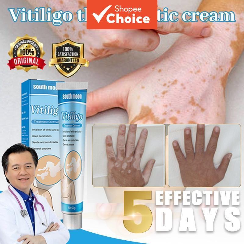 Creme Profissional South Moon para Manchas Brancas na Pele 20g – Suporte para Vitiligo, Cuidado para Tom Uniforme,