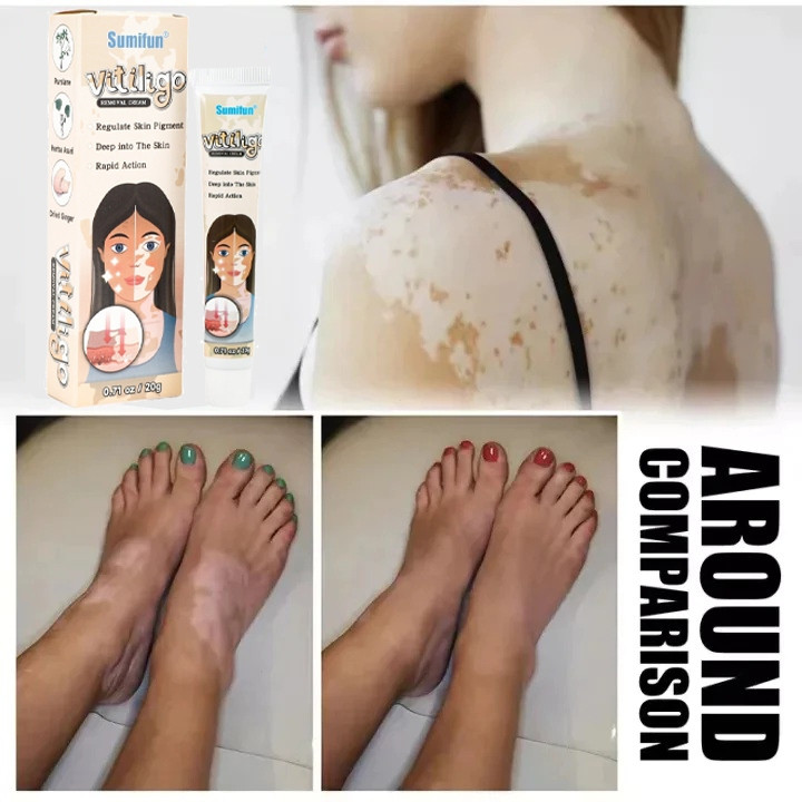 20g Creme De Tratamento De vitiligo Eficaz Removedor original Manchas Brancas Ervas Naturais *-& * -