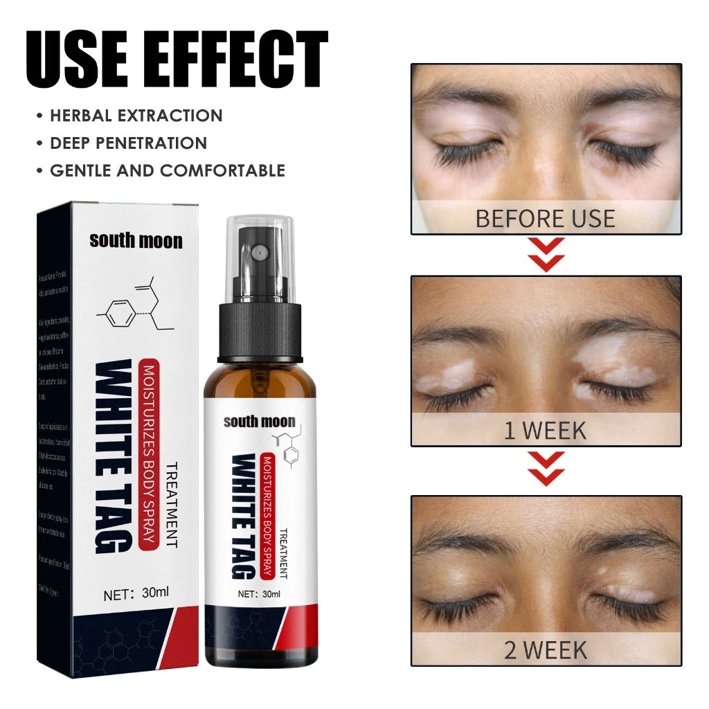 Em Estoque 30ml vitiligo Health spray Removedor De Mesmo Tom De Pele Líquido anti-ringworm Para Manchas Brancas Hidratan