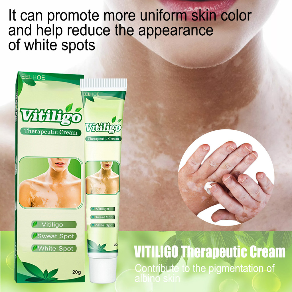 [LTO] Creme De Etiqueta Branca 20g , Exclusivo , Fácil De Usar , Extratos De Plantas , Terapêutico De Vitiligo Para Mulh