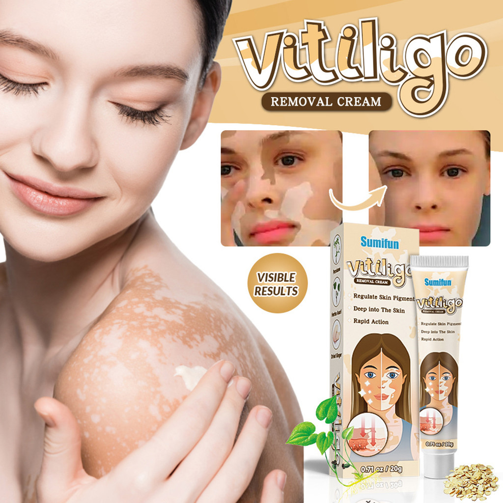 [LTO] Creme De Tratamento De Vitiligo 20g , Absorção Rápida , Regula O Pigmento Da Pele , Profissional De Remoção De Cui