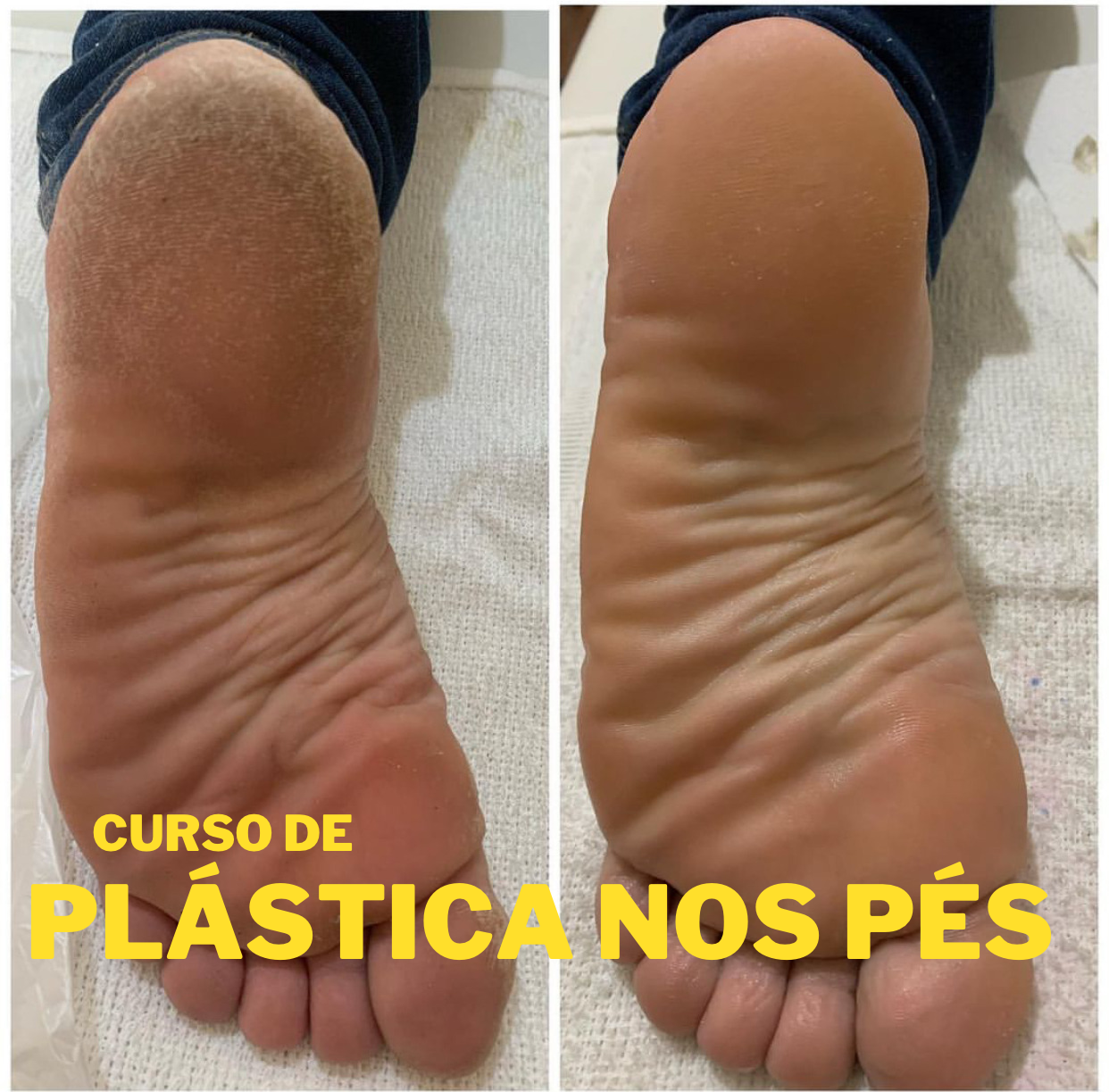 Curso plástica nos pés