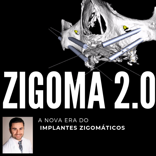 ZIGOMA 2.0 - A Nova Era dos Implantes Zigomáticos